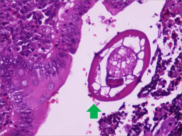 Cross-section-of-E-vermicularis-in-the-appendiceal-lumen-Note-the-characteristic-pair.png