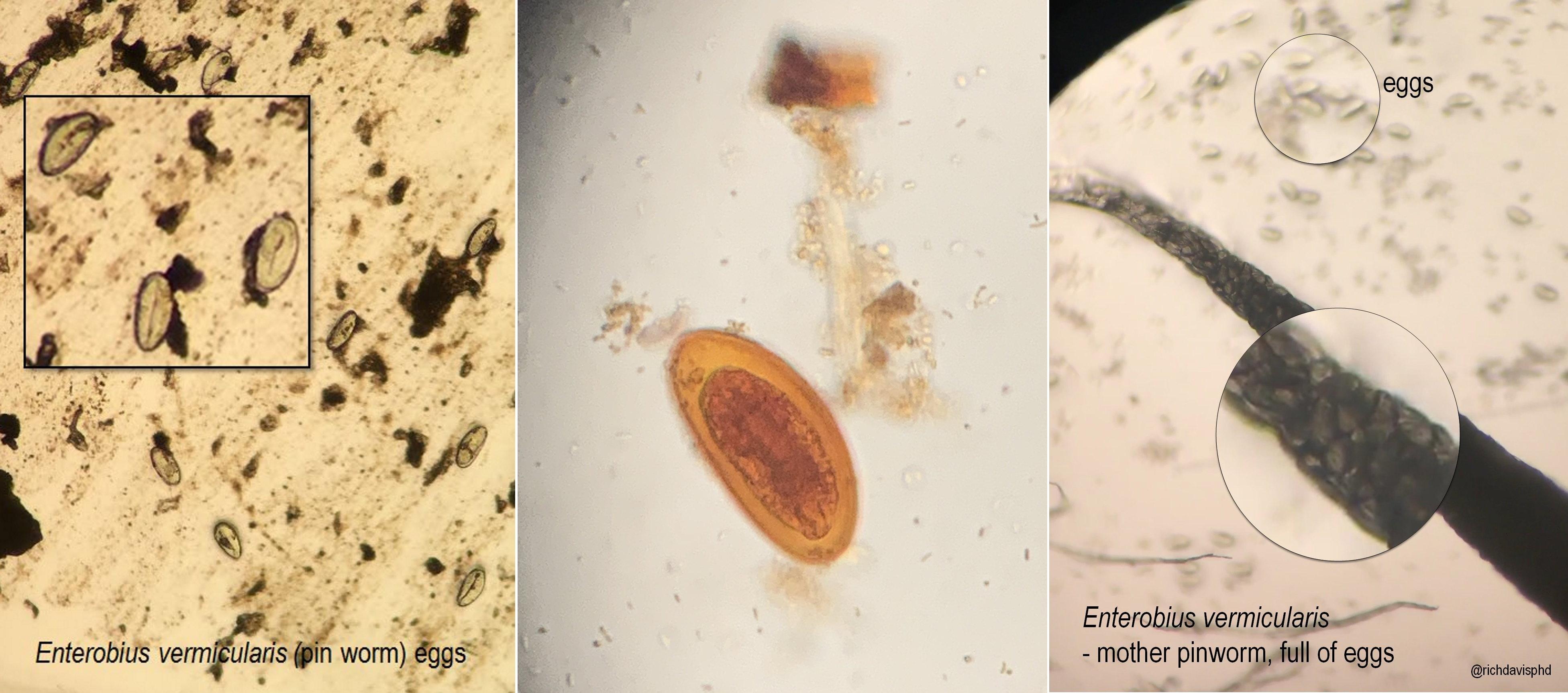 microbiology-clinical-enterobius-vermicularis-microscopy-original.jpeg