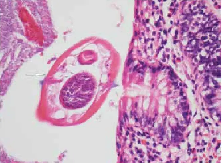 Enterobius-vermicularis-in-the-lumen-of-the-appendix-vermicularis-arrow-HEx10.png
