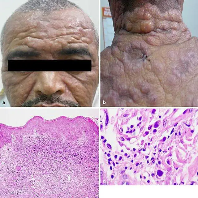 a-Pachydermic-infiltration-of-the-forehead-of-the-patient-with-myeloid-leukemia-cutis-b_Q640.jpg